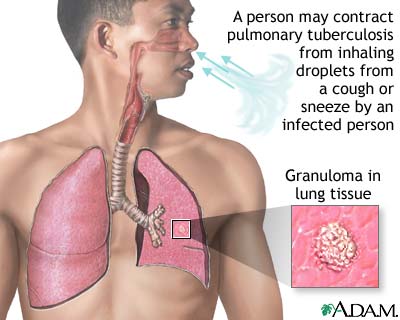 Scientists discover ethnic differences in immune response to TB bacterium