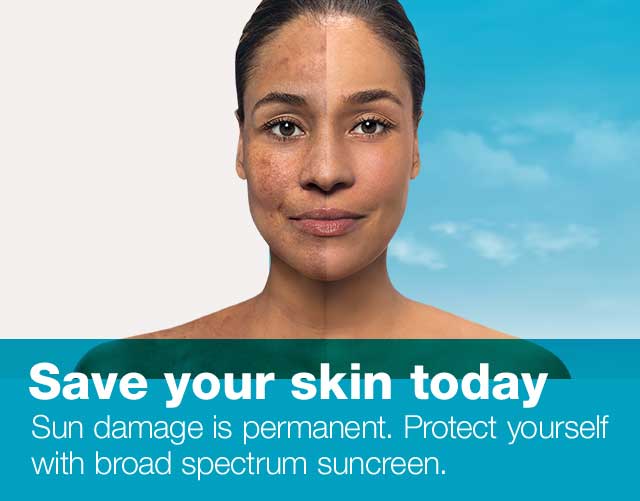Save your skin today. Sun damage is permanent. Protect yourself with broad spectrum sunscreen.