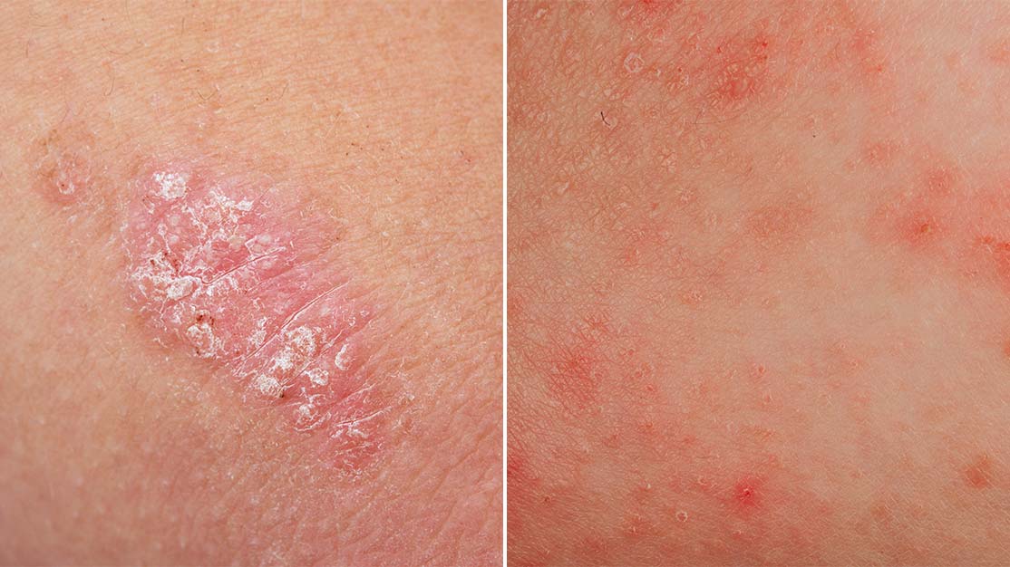 Difference Between Eczema And Psoriasis Health Answers Walgreens