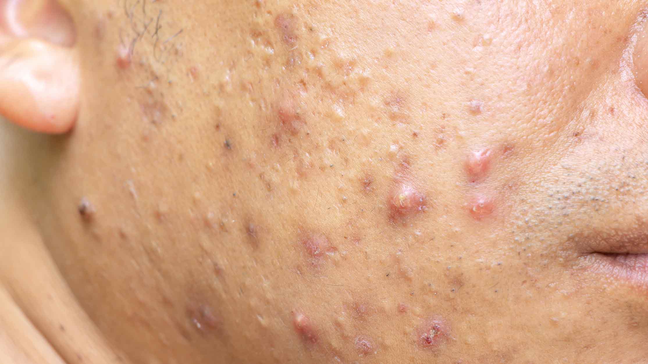 Nodular Acne | Health Answers | Walgreens