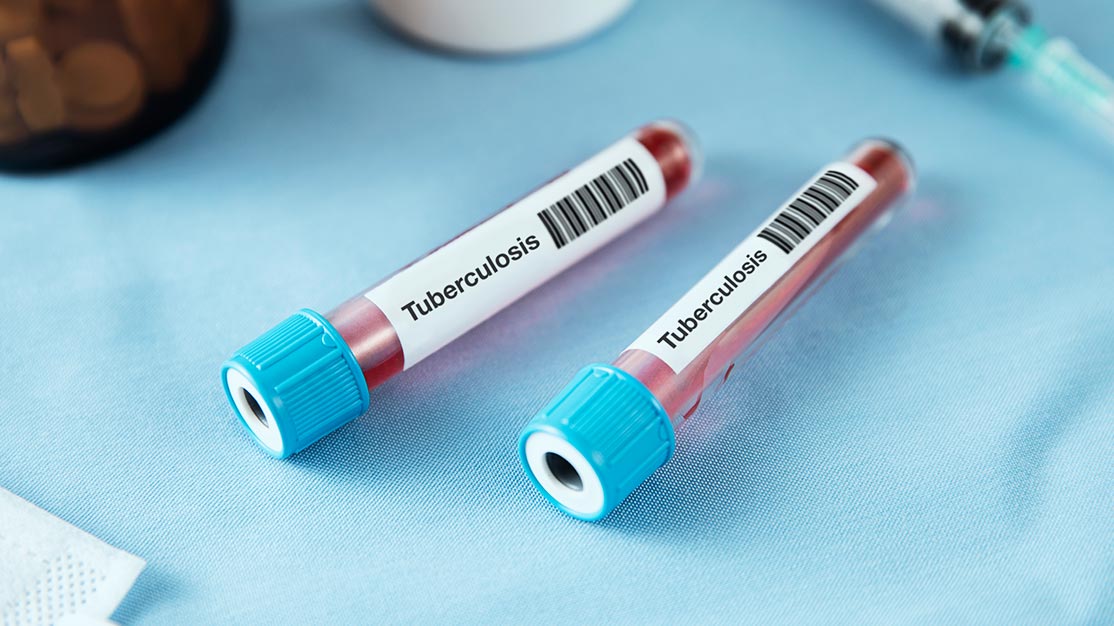 Tuberculosis Testing