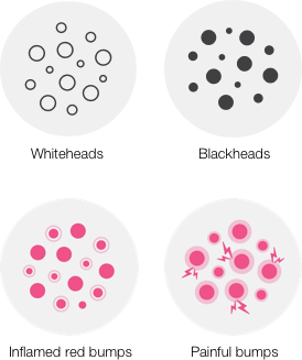 Whiteheads, Blackheads, Inflamed red bumps, Painful bumps