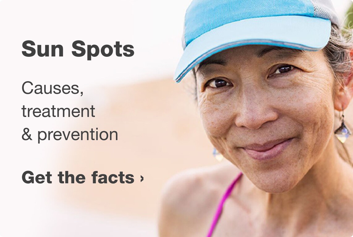 Sun Spots Causes, treatment & prevention. Get the facts.